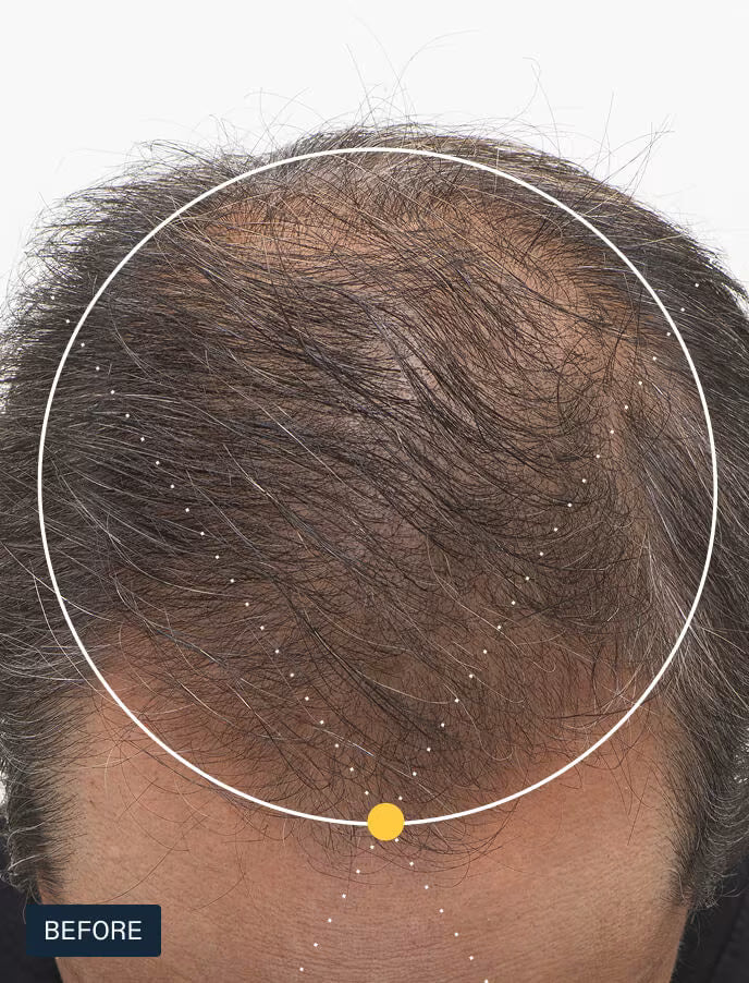 Nutrafol for Men 50+ Hair Growth Nutraceutical - 3-month